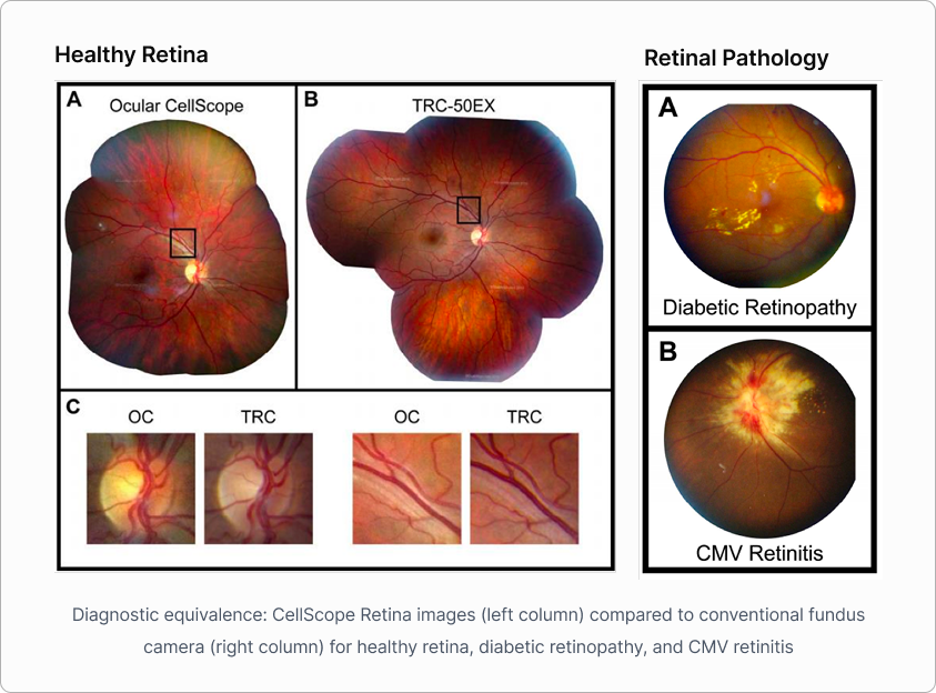 Diagnostic equivalence: Ocular CellScope vs conventional fundus camera for healthy retina, diabetic retinopathy, and CMV retinitis